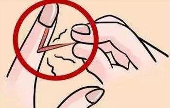 寶寶手指出現(xiàn)倒刺是怎么回事？需要補充維生素嗎？